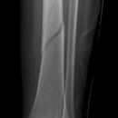 Spiralfraktur Tibia