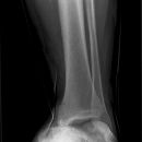 Totale Talusluxation