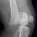 Traumatische Epiphysenlösung