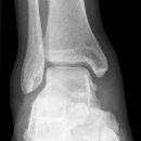 Vorderes Volkmann + lat. Talusschulter