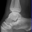 Vorderes Volkmann + lat. Talusschulter